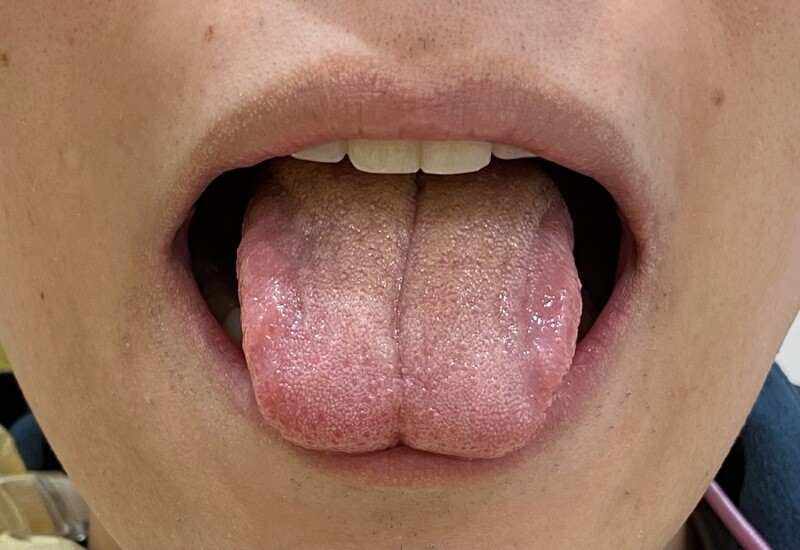 舌小帯切除術 術前